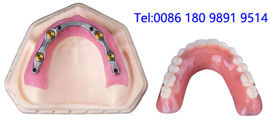 Full  Denture Implants.jpg